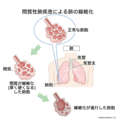 間質性肺疾患